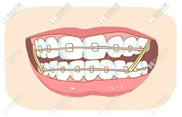 煙臺(tái)口腔醫(yī)院整牙做牙齒矯正收費(fèi)多少錢