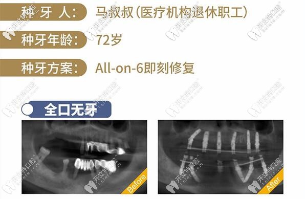 南寧柏樂口腔醫(yī)院種植牙技術(shù)咋樣?醫(yī)生列表的彭布強(qiáng)可靠嗎