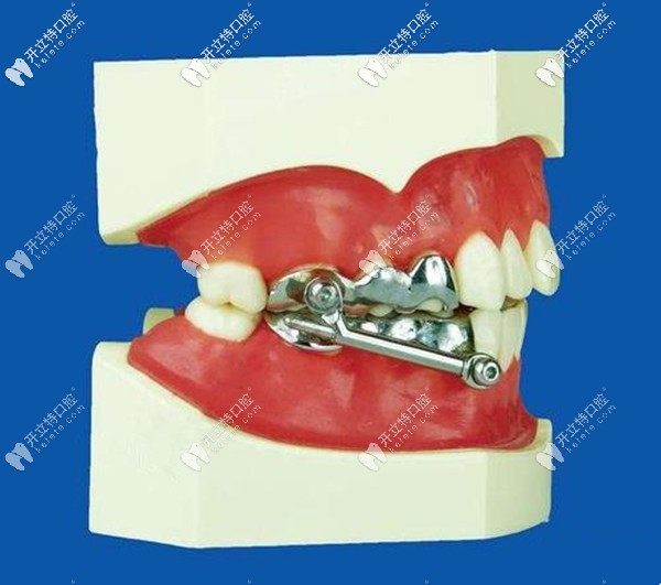 herbest矯正下頜后縮價格貴嗎?談?wù)勗砑靶g(shù)后改變成效