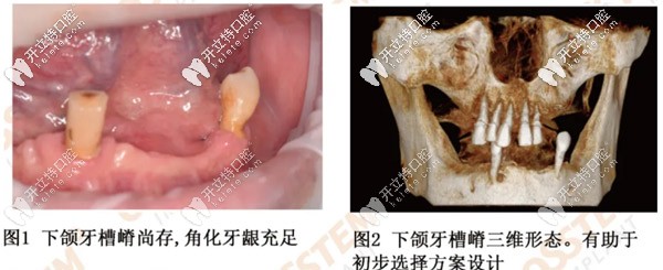 下頜無(wú)牙者利用奧齒泰轉(zhuǎn)換基臺(tái)完成了數(shù)字化導(dǎo)板即刻修復(fù)