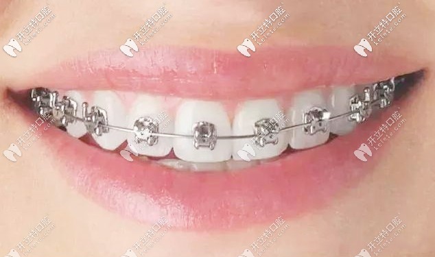 金屬自鎖托槽矯正