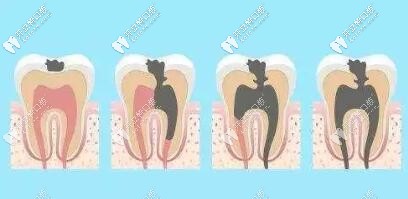 齲齒發(fā)展過程