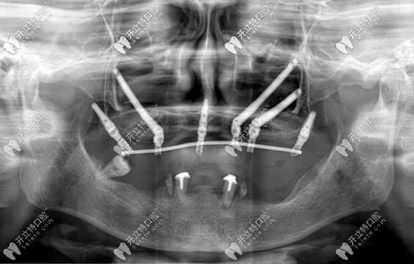 關于穿顴骨穿翼板種植牙要多少錢,參考價格看完便知