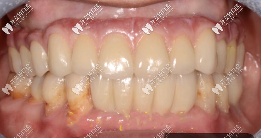 老媽做的上半口種植牙效果圖 老媽做的上半口種植牙效果圖