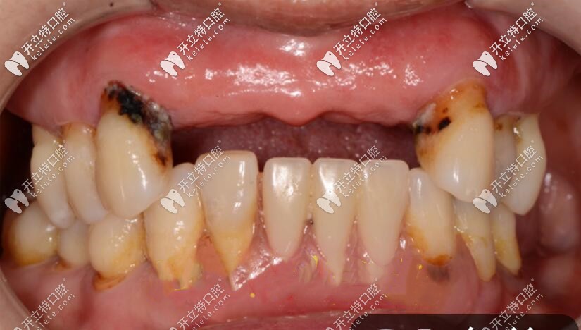 上半口多顆門牙掉光的照片 上半口多顆門牙掉光的照片