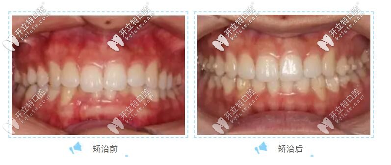 牙列擁擠戴美悅隱形牙套前后圖