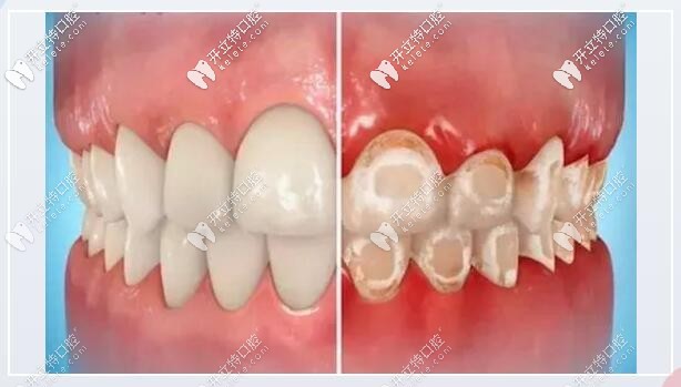 不建議長期使用小蘇打刷牙 ，會損害牙釉質(zhì)，破壞牙本質(zhì)。