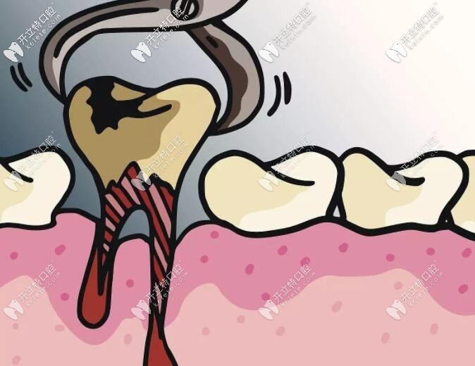 拔牙創(chuàng)口是不是比種牙大 拔牙創(chuàng)口是不是比種牙大