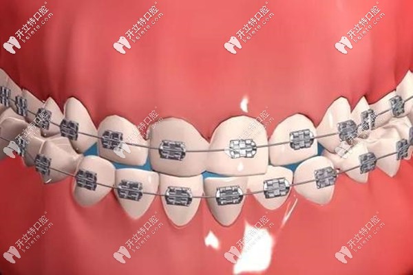寶山區(qū)羅緣口腔金屬鋼牙套