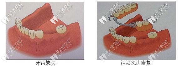 活動(dòng)義齒修復(fù)后圖示