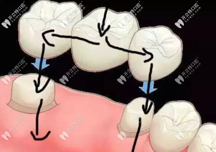 用類似的連橋牙冠修改也不會崩瓷