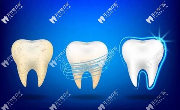 諾貝爾牙齒美白<span style=