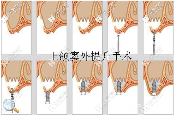 上額竇外提升的圖解