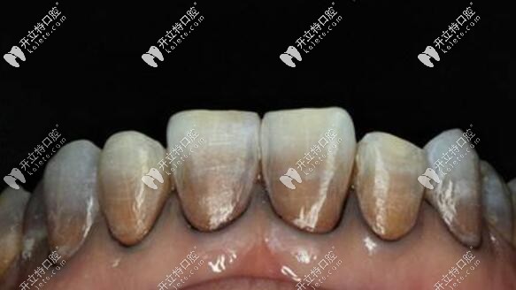 瑞典全瓷冠對圖片中的重度四環(huán)素牙有不錯效果