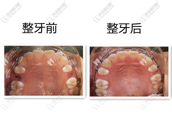 勁松口腔的正畸