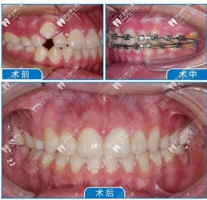 牙齒反頜自鎖托槽矯正
