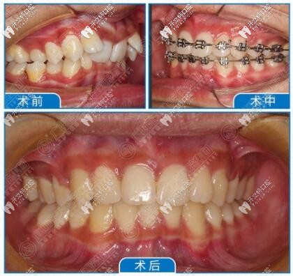 牙齒擁擠戴自鎖牙套矯正
