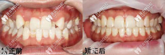 沈陽(yáng)億美佳口腔的矯正案例
