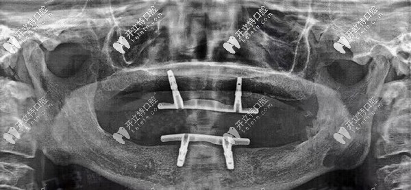 陳叔叔口腔檢查情況 陳叔叔口腔檢查情況