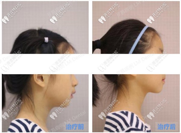 兒童深覆合矯正前后臉型對比