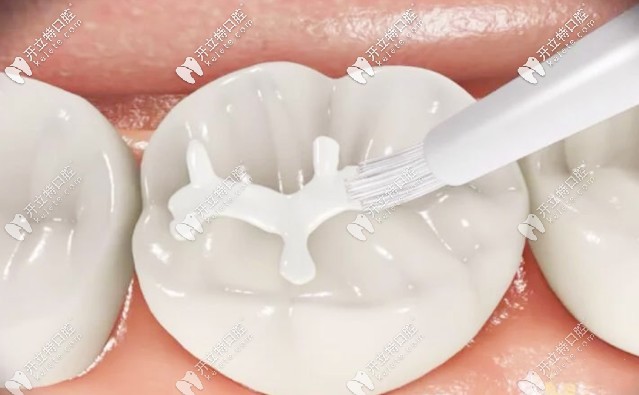 德國voco納米具有半透明性