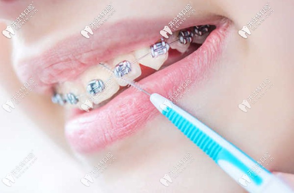 榆次區(qū)萊特口腔的牙齒矯正參考價格