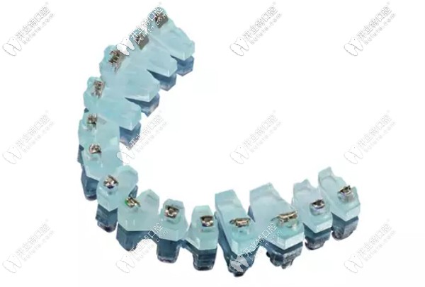 奧世美數(shù)字化金屬自鎖牙套的價格、優(yōu)勢及矯正效果解析~