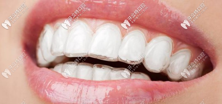 隱形矯正技術(shù) 隱形矯正技術(shù)