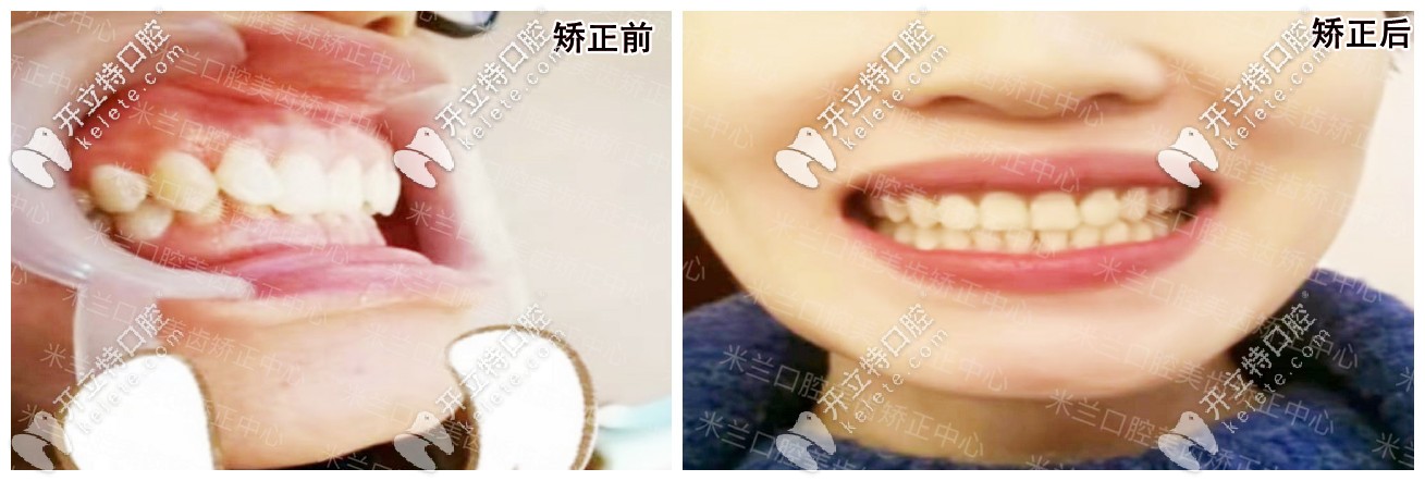這位女士到沈陽米蘭矯正后的效果