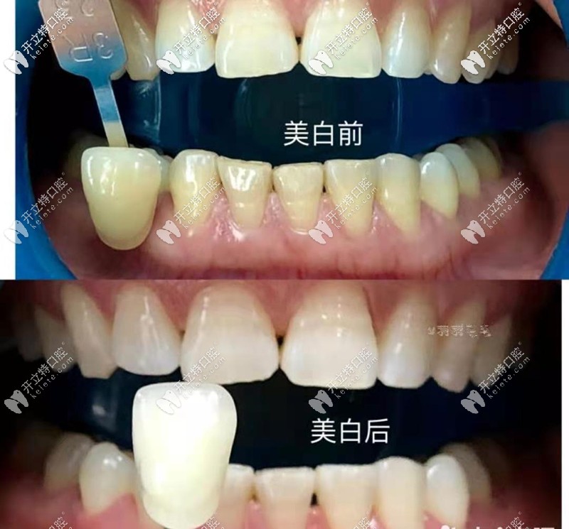 黃牙在西安曲江牙科做了冷光美白白了3個度,這價格值了