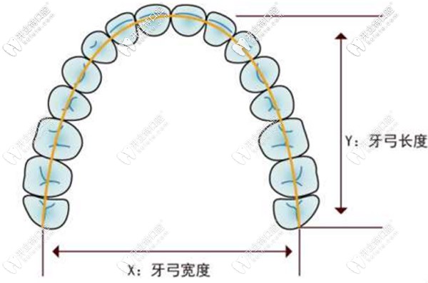 8-14歲的兒童使用牙齒擴(kuò)弓的費用大概是多少？