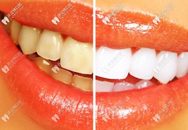 廣州市的牙齒修復價格