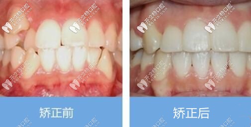 <!--<i data=20240703-sp></i>-->口腔矯正案例