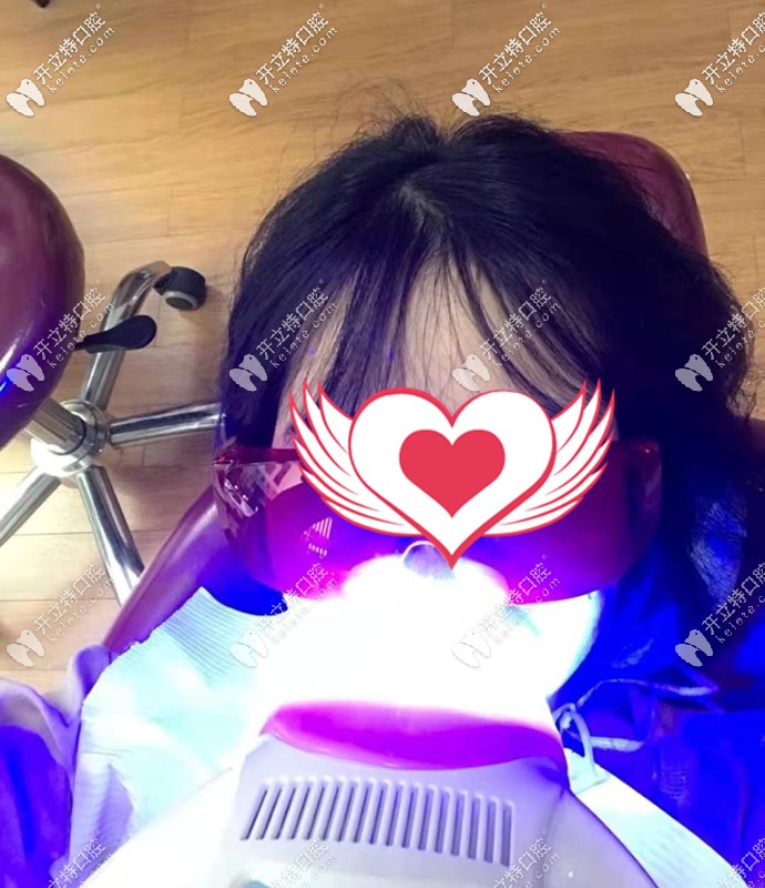 西安佳美口腔牙齒美白案例 西安佳美口腔牙齒美白案例