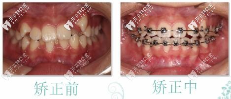 張醫(yī)生：牙齒參差不齊，正在矯正中