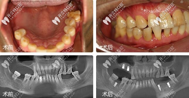 深圳麥芽口腔鄭蒼尚院長(zhǎng)微創(chuàng)種植牙案例 深圳麥芽口腔鄭蒼尚院長(zhǎng)微創(chuàng)種植牙案例