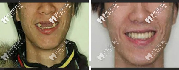 ALL- on-4種植牙技術(shù)修復(fù)