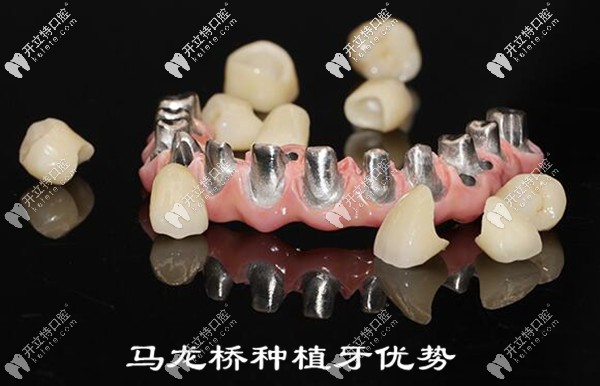 馬龍橋種植牙的優(yōu)缺點(diǎn) 馬龍橋種植牙的優(yōu)缺點(diǎn)