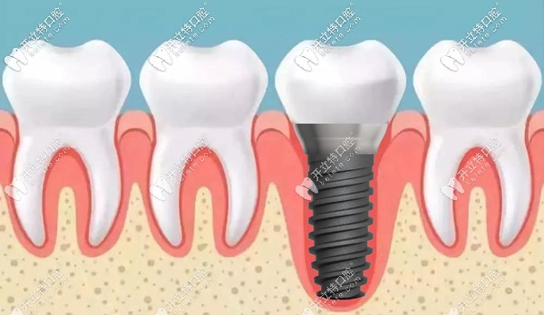 東營各口腔醫(yī)院價格表已出，瞅瞅東營做種植牙一般多少錢