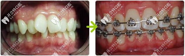 平江致遠(yuǎn)口腔：孫醫(yī)生完成的金屬牙套<span style=