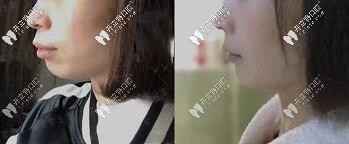 深覆合、齙牙顧客—拔牙7顆做的美國進(jìn)口自鎖金屬托槽