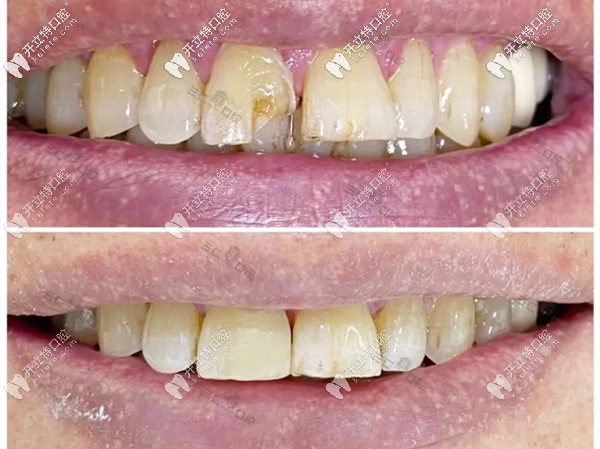 芭芭拉醫(yī)生的門牙修復(fù)案例圖