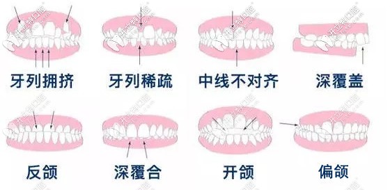  渭南牙科做牙齒矯正多少錢？想知道隱形和金屬矯正的價(jià)格