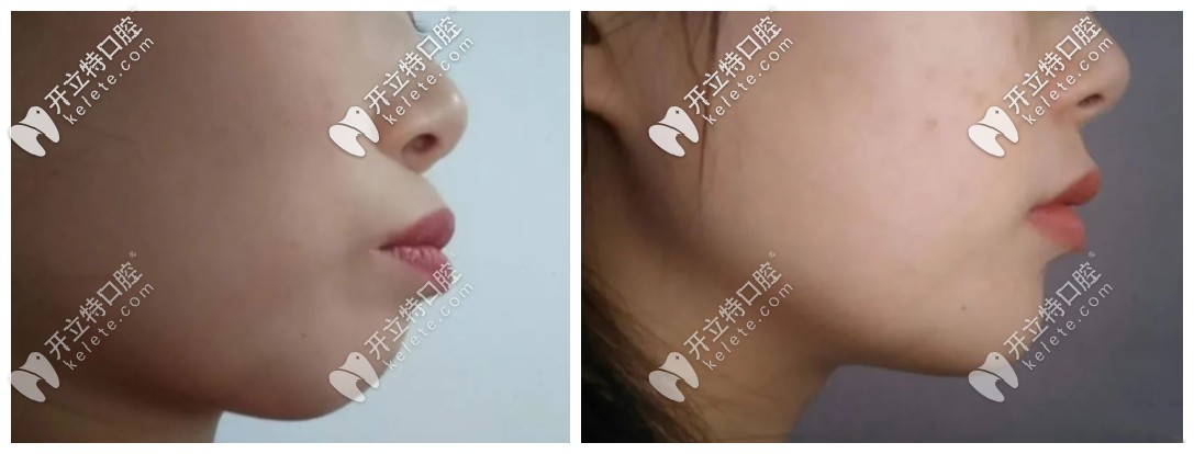 牙齒內(nèi)收5毫米側(cè)面臉型對(duì)比圖