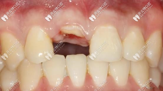 前牙區(qū)應用盾構(gòu)術(shù)進行即刻種植案例更新,美學效果更贊！