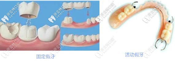 烤瓷牙和活動義齒區(qū)別