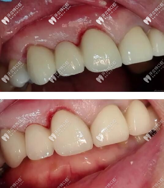 殘根帶牙冠修復案例