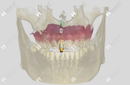 導(dǎo)板種植對(duì)于植體的角度和深度調(diào)整
