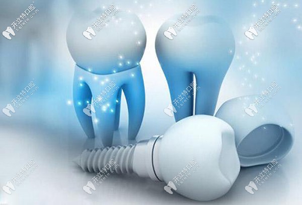 種植牙選純鈦和鈦合金材料有啥區(qū)別，做核磁共振有影響嗎