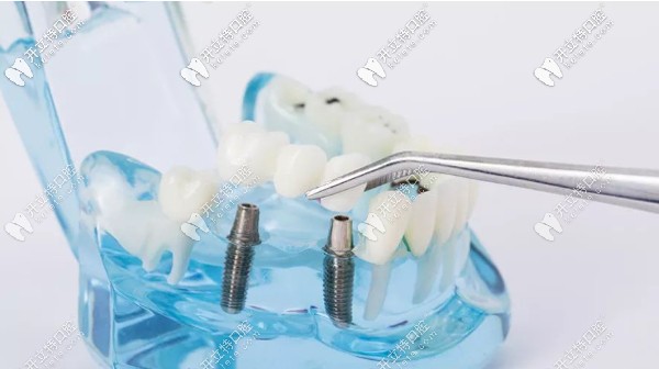 烤瓷牙冠會(huì)影響核磁共振診斷